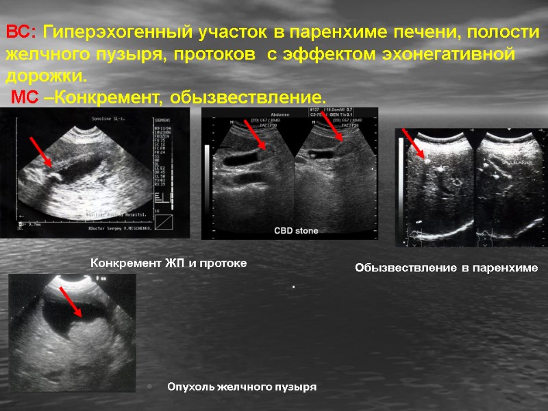ВС: Гиперэхогенный участок в паренхиме печени, полости желчного пузыря, протоков  с эффектом эхонегативной